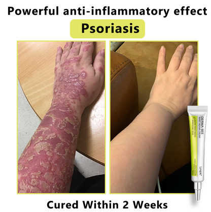 【 𝐿𝑚𝑖𝑝𝑘𝑖®Official Store】𝙇𝙢𝑖𝑝𝙠𝙞® Derma  Repair Cream👩🏼‍⚕️(𝗔𝗽𝗽𝗹𝘆 𝘁𝘄𝗶𝗰𝗲 𝗱𝗮𝗶𝗹𝘆, 𝘄𝗮𝗿𝘁-𝗳𝗿𝗲𝗲 𝗿𝗲𝘀𝘂𝗹𝘁𝘀 𝗶𝗻 𝟮–𝟯 𝘄𝗲𝗲𝗸𝘀) ✅ 𝐅𝐨𝐫 𝒔𝒌𝒊𝒏 𝒕𝒂𝒈, 𝒘𝒓𝒊𝒏𝒌𝒍𝒆𝒔, 𝒗𝒊𝒕𝒊𝒍𝒊𝒈𝒐, 𝒓𝒐𝒔𝒂𝒄𝒆𝒔, 𝒆𝒄𝒛𝒎𝒂, 𝒖𝒓𝒕𝒊𝒄𝒂𝒓𝒊𝒂, 𝒅𝒓𝒚 𝒂𝒏𝒅 𝒇𝒍𝒂𝒌𝒚, 𝐚𝐧𝐝 𝐦𝐨𝐫𝐞