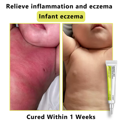 【 𝐿𝑚𝑖𝑝𝑘𝑖®Official Store】𝙇𝙢𝑖𝑝𝙠𝙞® Derma  Repair Cream👩🏼‍⚕️(𝗔𝗽𝗽𝗹𝘆 𝘁𝘄𝗶𝗰𝗲 𝗱𝗮𝗶𝗹𝘆, 𝘄𝗮𝗿𝘁-𝗳𝗿𝗲𝗲 𝗿𝗲𝘀𝘂𝗹𝘁𝘀 𝗶𝗻 𝟮–𝟯 𝘄𝗲𝗲𝗸𝘀) ✅ 𝐅𝐨𝐫 𝒔𝒌𝒊𝒏 𝒕𝒂𝒈, 𝒘𝒓𝒊𝒏𝒌𝒍𝒆𝒔, 𝒗𝒊𝒕𝒊𝒍𝒊𝒈𝒐, 𝒓𝒐𝒔𝒂𝒄𝒆𝒔, 𝒆𝒄𝒛𝒎𝒂, 𝒖𝒓𝒕𝒊𝒄𝒂𝒓𝒊𝒂, 𝒅𝒓𝒚 𝒂𝒏𝒅 𝒇𝒍𝒂𝒌𝒚, 𝐚𝐧𝐝 𝐦𝐨𝐫𝐞