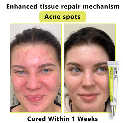 【 𝐿𝑚𝑖𝑝𝑘𝑖®Official Store】𝙇𝙢𝑖𝑝𝙠𝙞® Derma  Repair Cream👩🏼‍⚕️(𝗔𝗽𝗽𝗹𝘆 𝘁𝘄𝗶𝗰𝗲 𝗱𝗮𝗶𝗹𝘆, 𝘄𝗮𝗿𝘁-𝗳𝗿𝗲𝗲 𝗿𝗲𝘀𝘂𝗹𝘁𝘀 𝗶𝗻 𝟮–𝟯 𝘄𝗲𝗲𝗸𝘀) ✅ 𝐅𝐨𝐫 𝒔𝒌𝒊𝒏 𝒕𝒂𝒈, 𝒘𝒓𝒊𝒏𝒌𝒍𝒆𝒔, 𝒗𝒊𝒕𝒊𝒍𝒊𝒈𝒐, 𝒓𝒐𝒔𝒂𝒄𝒆𝒔, 𝒆𝒄𝒛𝒎𝒂, 𝒖𝒓𝒕𝒊𝒄𝒂𝒓𝒊𝒂, 𝒅𝒓𝒚 𝒂𝒏𝒅 𝒇𝒍𝒂𝒌𝒚, 𝐚𝐧𝐝 𝐦𝐨𝐫𝐞