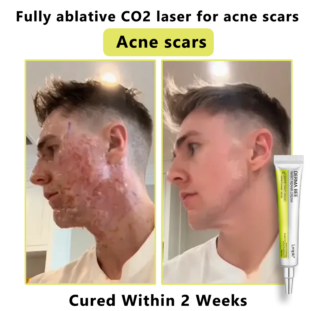 【 𝐿𝑚𝑖𝑝𝑘𝑖®Official Store】𝙇𝙢𝑖𝑝𝙠𝙞® Derma  Repair Cream👩🏼‍⚕️(𝗔𝗽𝗽𝗹𝘆 𝘁𝘄𝗶𝗰𝗲 𝗱𝗮𝗶𝗹𝘆, 𝘄𝗮𝗿𝘁-𝗳𝗿𝗲𝗲 𝗿𝗲𝘀𝘂𝗹𝘁𝘀 𝗶𝗻 𝟮–𝟯 𝘄𝗲𝗲𝗸𝘀) ✅ 𝐅𝐨𝐫 𝒔𝒌𝒊𝒏 𝒕𝒂𝒈, 𝒘𝒓𝒊𝒏𝒌𝒍𝒆𝒔, 𝒗𝒊𝒕𝒊𝒍𝒊𝒈𝒐, 𝒓𝒐𝒔𝒂𝒄𝒆𝒔, 𝒆𝒄𝒛𝒎𝒂, 𝒖𝒓𝒕𝒊𝒄𝒂𝒓𝒊𝒂, 𝒅𝒓𝒚 𝒂𝒏𝒅 𝒇𝒍𝒂𝒌𝒚, 𝐚𝐧𝐝 𝐦𝐨𝐫𝐞